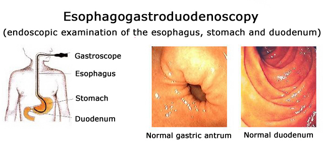 Endoscopy