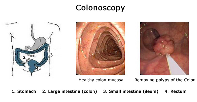 colonoscopy